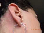 This is what the scar looks like behind my ear.  I can't ware sunglasses for very long before it really starts to hurt.  This is Oct. 28,2010 almost one year out.