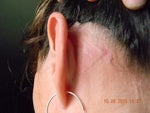Behind left ear. Not as bad looking but the lump from the scar hurts when touched.