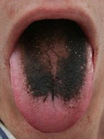 Hairy Black Tongue? Maybe it's the skin condition meds