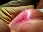 I am 12 days post breast reduction: 36dd  to 36 small c.  I an starting to have wound issues