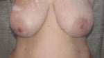 Before Breast Reduction Surgery