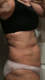 Side view post 2 days