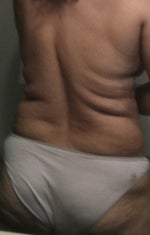 Back view post 2 days