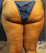 Back thighs pre (post tummy which is where the left swelling is from)