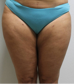 Front thighs 2 months