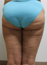 Back thighs 2 months