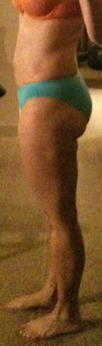 SIDE 6 months post but PRE-touch-up (-35 lbs from pre)