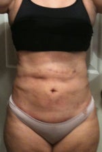 Front 2 days post