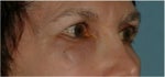 Sculptra under eyes
