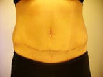 Tummy Tuck post-op