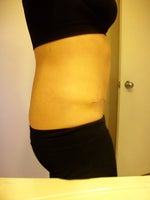 Tummy Tuck post-op