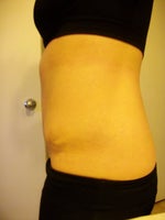 Tummy Tuck post-op