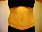 Tummy Tuck post-op