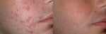 Accutane before and after photos