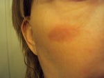 Laser treatment