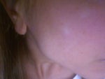 Be Careful with Active Fx Laser Treatments - Pennsylvania - Fraxel ...