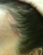 My hairline was severely displaced. Now have bald spot & very visible scar.