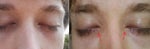 Pictures showing my eyelid closure problem.