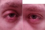 Pictures showing the droopy upper eyelid on the right eye by comparison to left.