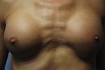 Implants Are Too Far Apart (pics): What Would You Suggest?