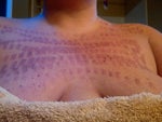 Have I been burned by my IPL treatment or is this normal?