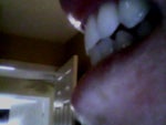 Have Jaw Pain After Invisalign, Supposedly Caused from an Overbite, Is ...