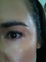 4 years after Sculptra, and 2 years after subscision procedure