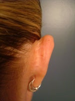 Right ear before