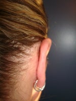 Right ear after (3 weeks later)