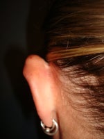 Left ear before