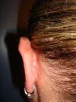 Left ear after (3 weeks later)