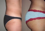 Week in Photos: Butt Augmentation