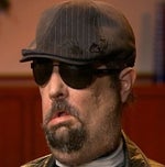 The First US Face Transplant Recipient Can Finally Smile