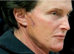 Bruce Jenner is Innocent: What a Facelift Scar Really Looks Like