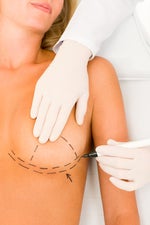 U.S. Breast Implant Population Is as Big as Singapore