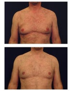 Doctors Say Don't Waste Your Money on Gynexin for Man Boobs