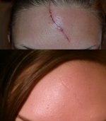 Forehead Scar - Best way to fix?