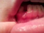 Infected lower implant