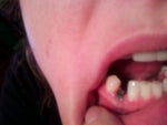 Implant showing through the gum- NOT supposed to look like this!