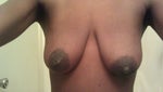 Is It Possible to Get a Quality Breast Augmentation for $3000-4000. Southern California?