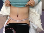 One Day Post Op what do you think?