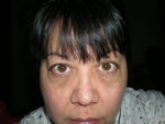 About a few weeks after injection. Again no make up in natural lighting.