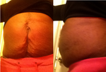 What Procedure is Right for Me?