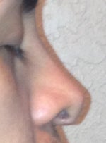 Revision Rhinoplasty
