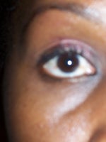 Is Restylane a viable option for under eyes?