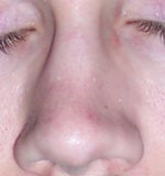 Can I get original look with rhinoplasty after broken nose & septoplasty?