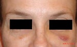 Is this normal bruising 2 days after Juvederm injection?