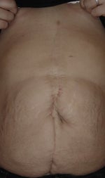 After multiple abdominal surgeries, is a tummy tuck possible?