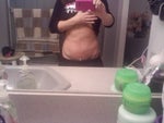 More swollen after 4 weeks post tummy tuck?