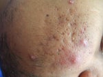 Is fraxel only hope for acne scarring and continued breakouts?